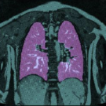 Towards 4D Object Modeling For Thoracic Insufficiency Syndrome cover